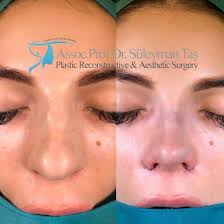 Thick Skin Bulbous Tip Rhinoplasty Assoc Prof Dr Suleyman Tas Rhinoplasty Nose Jobs Rhinoplasty Thick Skin