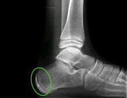 Image result for Calcaneal Apophysitis