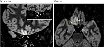 Depending on whether you get an mri in a traditional machine or a front open mri machine, a plastic coil/cage will be. Mri Scan Reveals Viral Brain Invasion Of Coronavirus Covid 19 Hospimedica Com