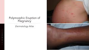 Image result for pruritic urticarial papules and plaques of pregnancy