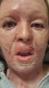 I fell face-first into a camp fire... #fbreels #shakemybeauty #burns  #burnsurvivor #survivor #selfacceptance