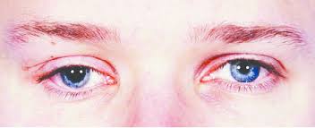 Partial right oculomotor nerve palsy with mild ptosis, mydriasis and a... |  Download Scientific Diagram