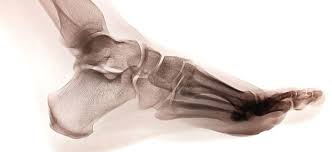 Bei der sogenannten überpronation knickt der fußrand sehr stark nach innen ein und belastet damit die bänder, sehnen und gelenke. Pronation Und Laufschuhe Joggen Net