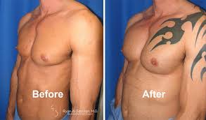 The main characteristic of poland syndrome are underdeveloped muscles on one side of the body, which results in problems with the chest, shoulder, arm or hand on that side of the body. Beverly Hills Pectoral Implants Los Angeles Chest Reconstruction Ryan Stanton Md
