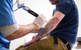 Quickly fade your unwanted tattoo. Tattoo Removal Cost In The Usa 2021 Ultimate Guide