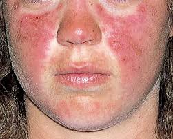 Educational image placeholder: skin rash and photosensitivity in lupus
