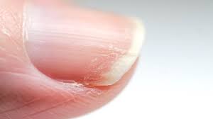 Our hair and nails contain which mineral. Zinc Deficiency And Nails Relationship Signs Treatment And More