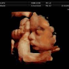People tell us that we have the best 3d ultrasound photo gallery comparing our 3d ultrasound photos with photos after baby's birth.we hope you will agree. Immobile Fetus At 31 Weeks Download Scientific Diagram