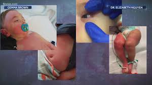 Image result for Multisystem Inflammatory Syndrome