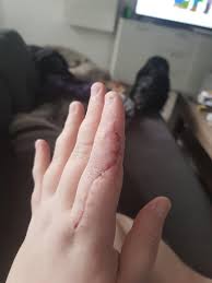 Image result for phlegmon of hand)