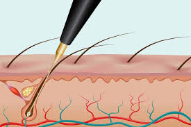 Social login does not work in incognito and private browsers. Does Electrolysis Work On White Or Gray Hair Stylecheer Com
