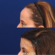 Forehead reduction surgery reduces its dimension and modifies the visual aspect of the eyebrows. Hairline Lowering Surgery Plastic Surgery