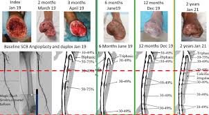 Image result for Sirolimus