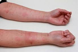 Severe allergic reactions (anaphylaxis) affect breathing and the heart, and can therefore be life threatening. Food Allergies In Children