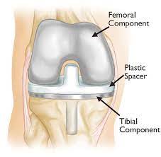 Total knee replacement surgery is a complex operation. Revision Total Knee Replacement Orthoinfo Aaos