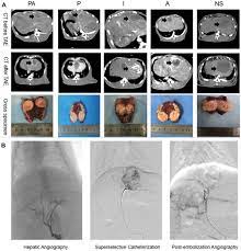 Effect Of Inhibiting Tumor Angiogenesis After Embolization In The Trea Jhc