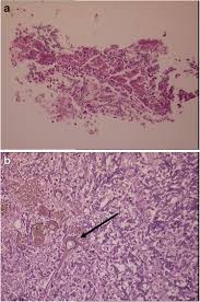 Brooder pneumonia in young birds. Aspergillus Nodules Another Presentation Of Chronic Pulmonary Aspergillosis Bmc Pulmonary Medicine Full Text