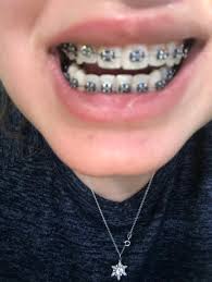 Mechanically removing the soft plaque will prevent the plaque from hardening into tartar. Adult Braces Reddit 5 Honest Invisalign Before After Reviews All New Teeth