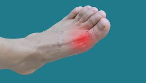 Image result for gout symptoms toe