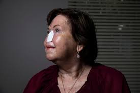 Cancer survivors join calls for federal government to fund facial  prosthetics