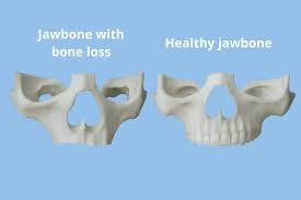 Image result for Maxillary Bone