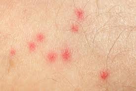 Bed bug bites are extremely itchy and can ruin a good night's sleep. Identify The Cause Of Your Itchy Bug Bite