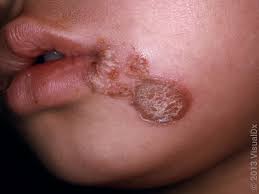 Image result for yellow scabs on the face in children