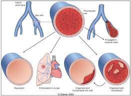 La thrombose est une maladie avec une formation de caillots sanguins à l'intérieur des vaisseaux. Thrombose Flashcards Quizlet