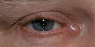 Image result for milium cyst on eyelid
