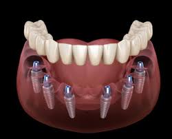 So sánh trồng răng giả và trồng răng Implant - Nha khoa Mai Hùng Group