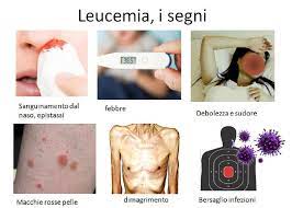 Ma la leucemia fulminante, o promielocitica, non solo è rarissima ma è anche perfettamente curabile, se affrontata per tempo e correttamente. Leucemia