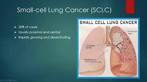 Tuberculosis (tb) is caused by bacteria (mycobacterium tuberculosis) that most often affect the lungs. Lung Cancer And Pulmonary Tb Youtube