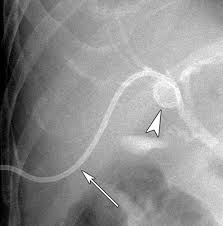 This can additionally be performed as part of a percutaneous transhepatic cholangiography , then a form of interventional radiology. Diagnosis And Management Of Complications From Percutaneous Biliary Tract Interventions Radiographics