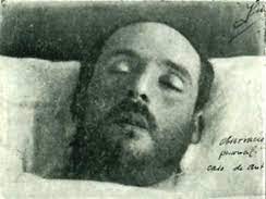 A betegségen átesett személyek katatón állapotba kerültek, nem mozogtak és nem beszéltek. Como Fue La Encefalitis Letargica En Espana Analisis De Los Casos Publicados Entre 1918 Y 1936 Neurologia Com