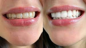 Für das bleaching für zuhause gibt es zwei verschiedene varianten: Zahne Bleichen Weisse Zahne In Wenigen Schritten Perfecthair Ch