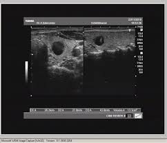 Sonographie Der Schilddruse