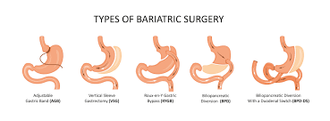 Bariatric Surgery Types Risk Cost Complications Narayana Health