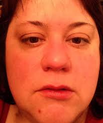 Update: I have gliotoxin exposure which is a mold. Explains a lot of my  symptoms and why SIBO and yeast just won't die! Does anybody know about  mast cell activation and how