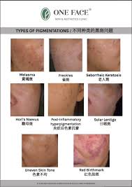 Pigmentation refers to the coloring of the skin. Pigmentation Removal Treatments A Guide By Dr David Ng C H One Face Skin Aesthetics Clinic
