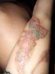 Your skin color might make removal difficult. Laser Tattoo Removal Will These Black Brown Dots Disappear When The Tattoo Is Completely Removed Photo