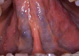 舌の裏側を見てみよう - のぼる君の歯科知識