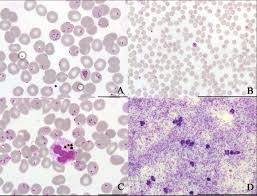 The parasite is transmitted through the bite of a female anopheles mosquito and causes the disease's most dangerous form, falciparum malaria. Delay In Diagnosis Malaria In A Returning Traveller Cmaj