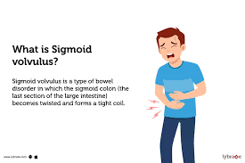 Image result for Sigmoid Volvulus