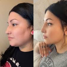 Hi everyone, I had a rhinoplasty 3 months ago, and my tip is still quite  large. I understand that swelling, especially with Afro rhinoplasty, can  take a long time to subside. Has