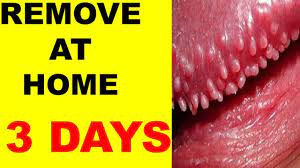 Tyson Glands Pearled Papules Remove In 3 Days At Home In Quarantine 2021  @Temple Music Br - Youtube
