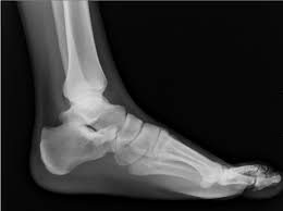 Dark navy blue vector realistic medial x ray of skeleton of foot with sesamoid bones. Podiatrist In Corona Sesamoiditis In Corona Advanced Care Foot And Ankle