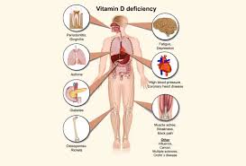 Vitamin D Deficiency