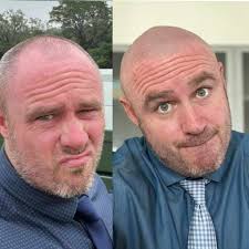 scalp micropigmentation soft hairline white guy houston austin san antonio  dallas