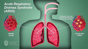Acute respiratory distress syndrome (ards) is a form of acute lung injury, which is characterised by severe hypoxemia in the absence of a cardiogenic cause. Ards Acute Respiratory Distress Syndrome St Vincent S Lung Health