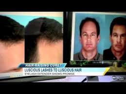 It was fda approved for growing longer eyelashes, but it is not approved for use on the scalp. Latisse For Scalp Hair Growth Good Morning America Abc Youtube